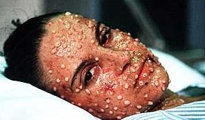 Smallpox-3.jpg