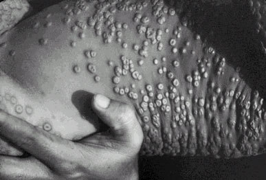 smallpox.jpg