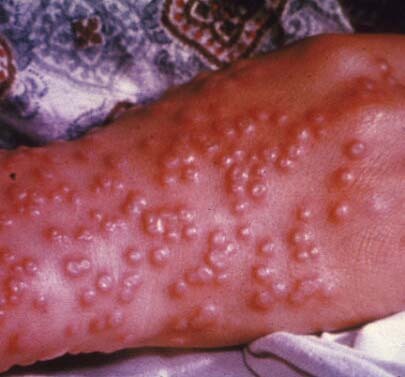 smallpox3.jpg