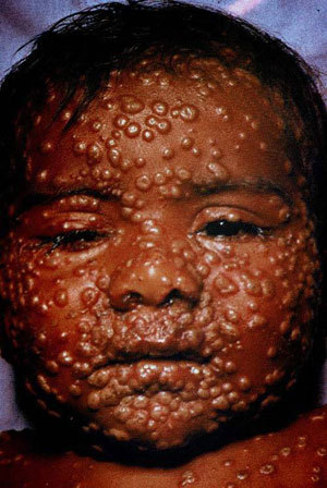 smallpox_day8sm.jpg